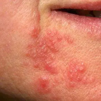 Perioral Dermatitis2
