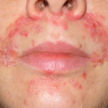 Perioral Dermatitis Pictures 1